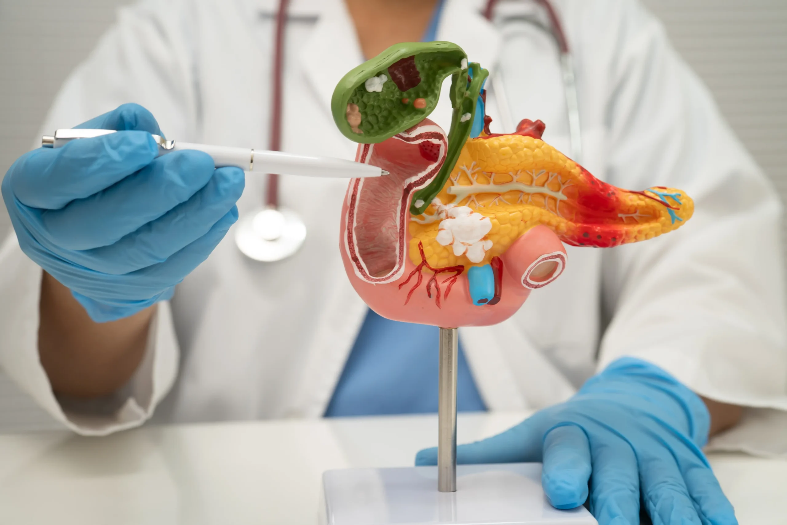 Pancreatic Cancer
