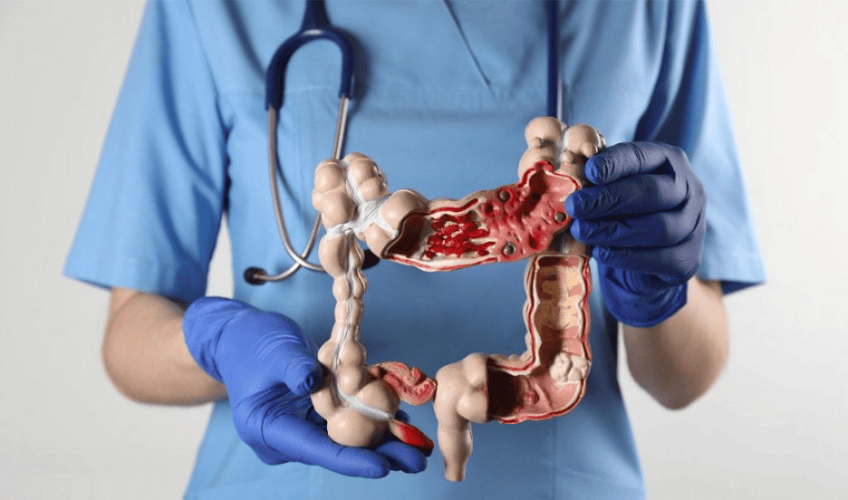 Surgeon holding anatomical colon model illustrating colorectal cancer diagnosis at Wellness Oncology and Hematology